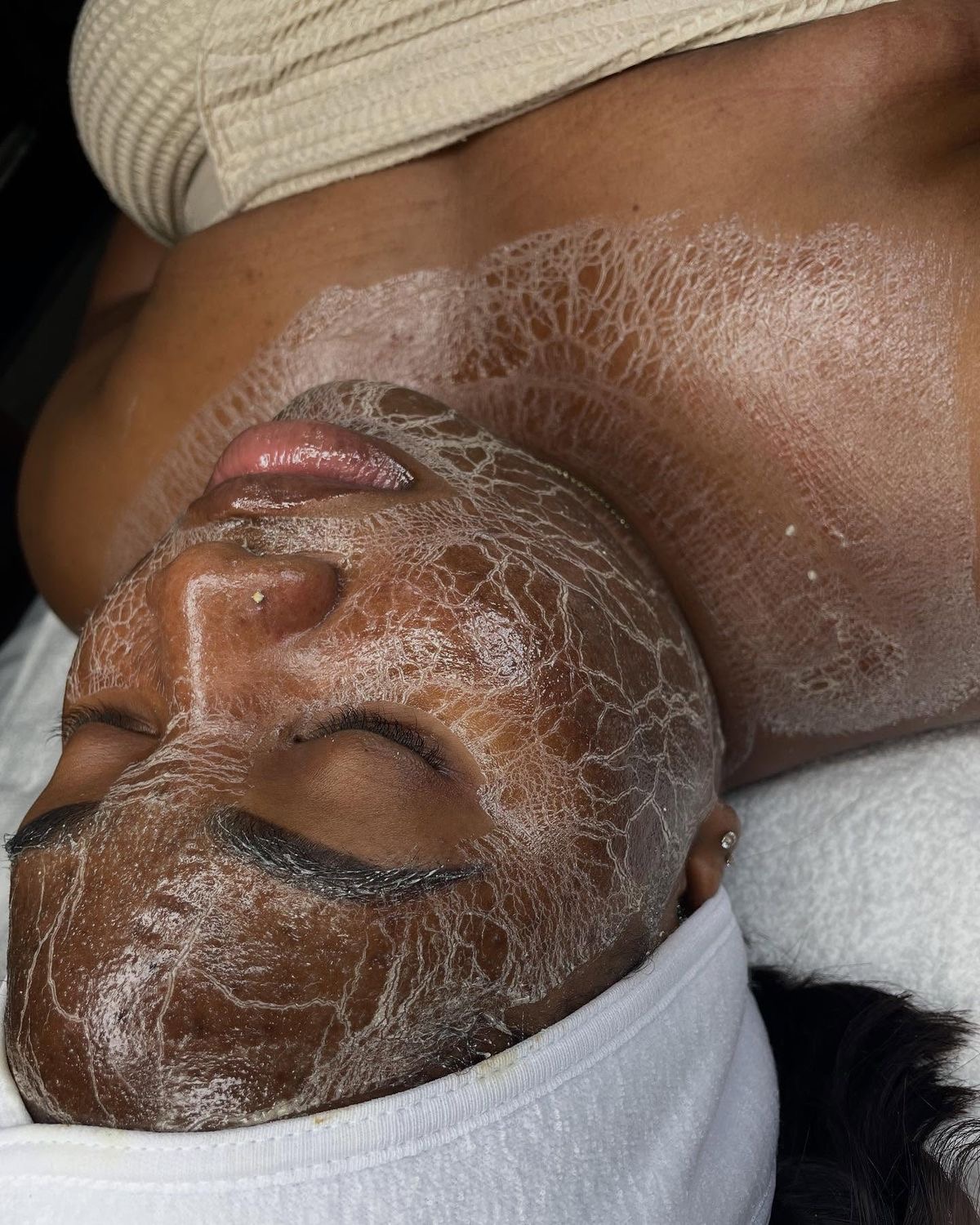 Chunusi/madoa na weusi